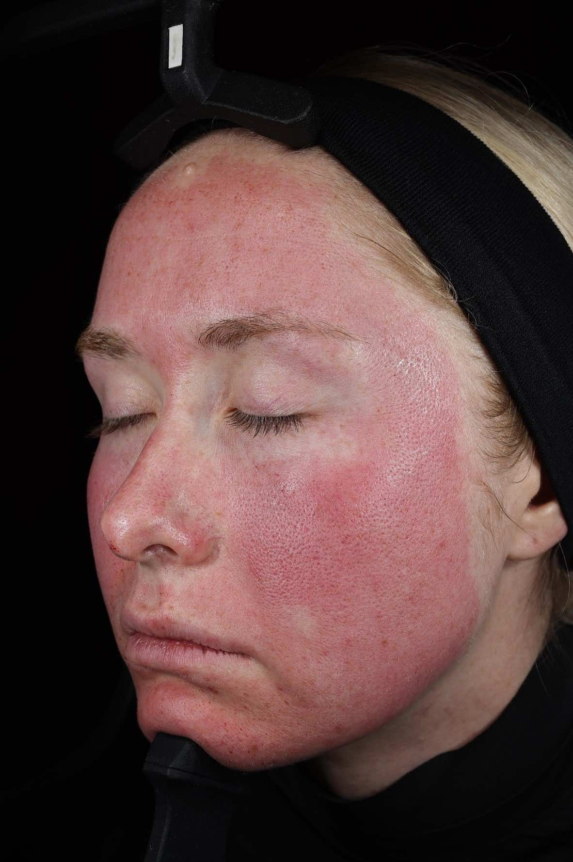 SkinPen treatment 1 Hour